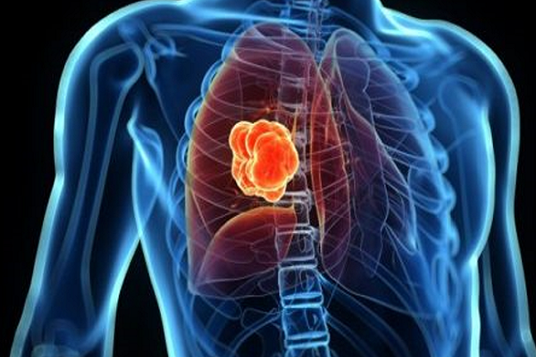Điều trị di căn xương trong ung thư phổi: Đột phá từ liệu pháp RANKL
