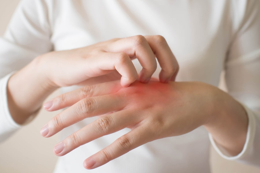 Dị ứng với nước: Căn bệnh hiếm khiến việc tắm cũng thành nỗi ám ảnh