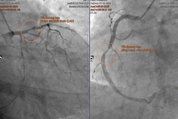 Lần đầu đặt stent tự tiêu cứu bệnh nhân nhồi máu cơ tim tại ĐBSCL