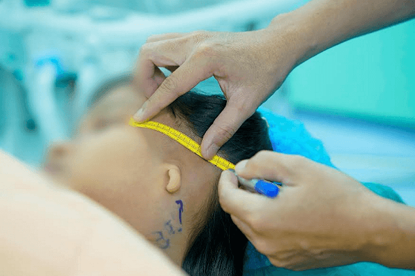 90% trẻ tai nhỏ bẩm sinh có thêm dị dạng ống tai, bác sĩ cảnh báo