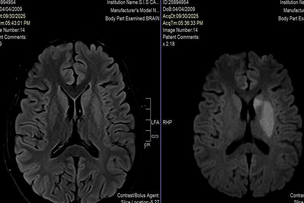 AI và MRI 3T mở rộng ‘cửa sổ vàng’ đột quỵ: Thay đổi cách tiếp cận hàng nghìn bệnh nhân