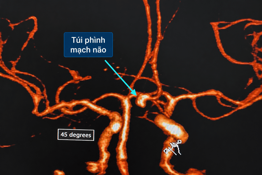 Túi phình động mạch não bất ngờ vỡ: Điều gì xảy ra trong cuộc đua giành sự sống?