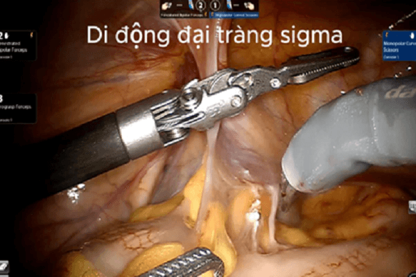 Mất bàng quang vì ung thư, bệnh nhân vẫn có thể ‘đi tiểu như thường’
